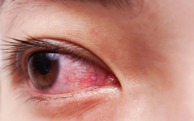 Cẩn thận với dịch đau mắt đỏ đang bùng phát